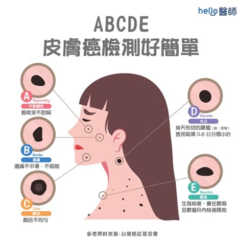 身體上的痣|痣變大、痣多或長毛會變皮膚癌？認識痣的形成與原因